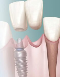 Dental Crown Bridge Clinic in Kolkata