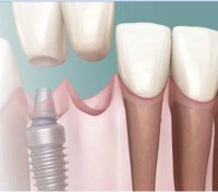 dental implant
