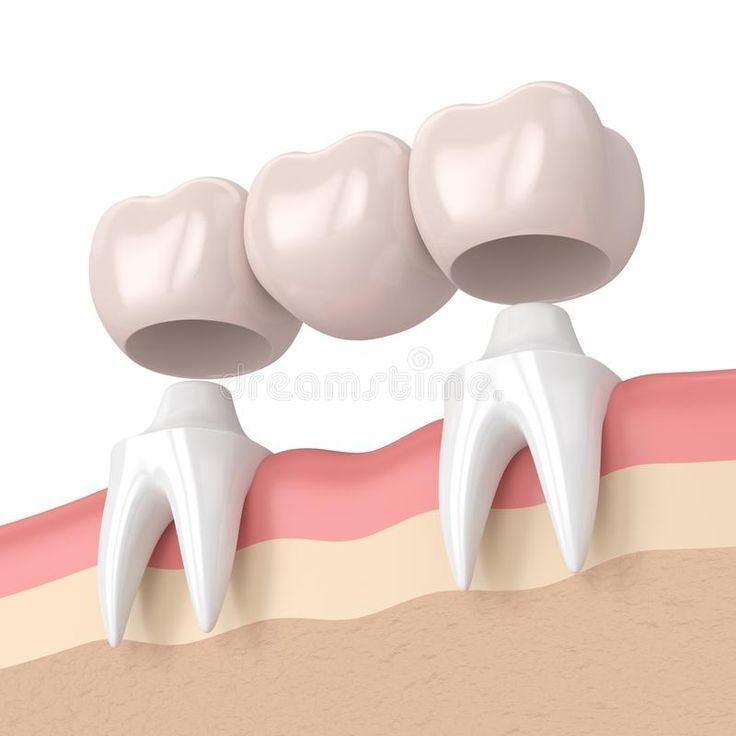 Dental crown and bridge 