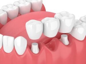 Read more about the article Dental Crown and Bridge Treatment in Kolkata – Restoring Smiles with Confidence