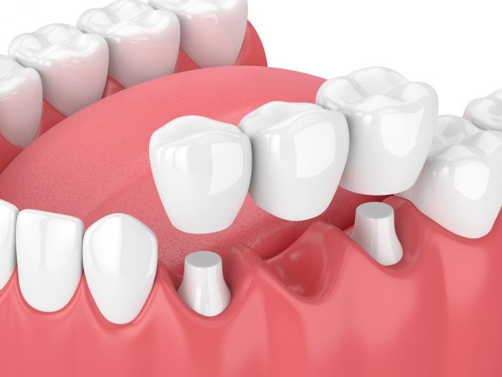 Read more about the article Dental Crown and Bridge Treatment in Kolkata – Restoring Smiles with Confidence