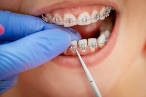 Read more about the article Orthodontic Treatment in Baghajatin