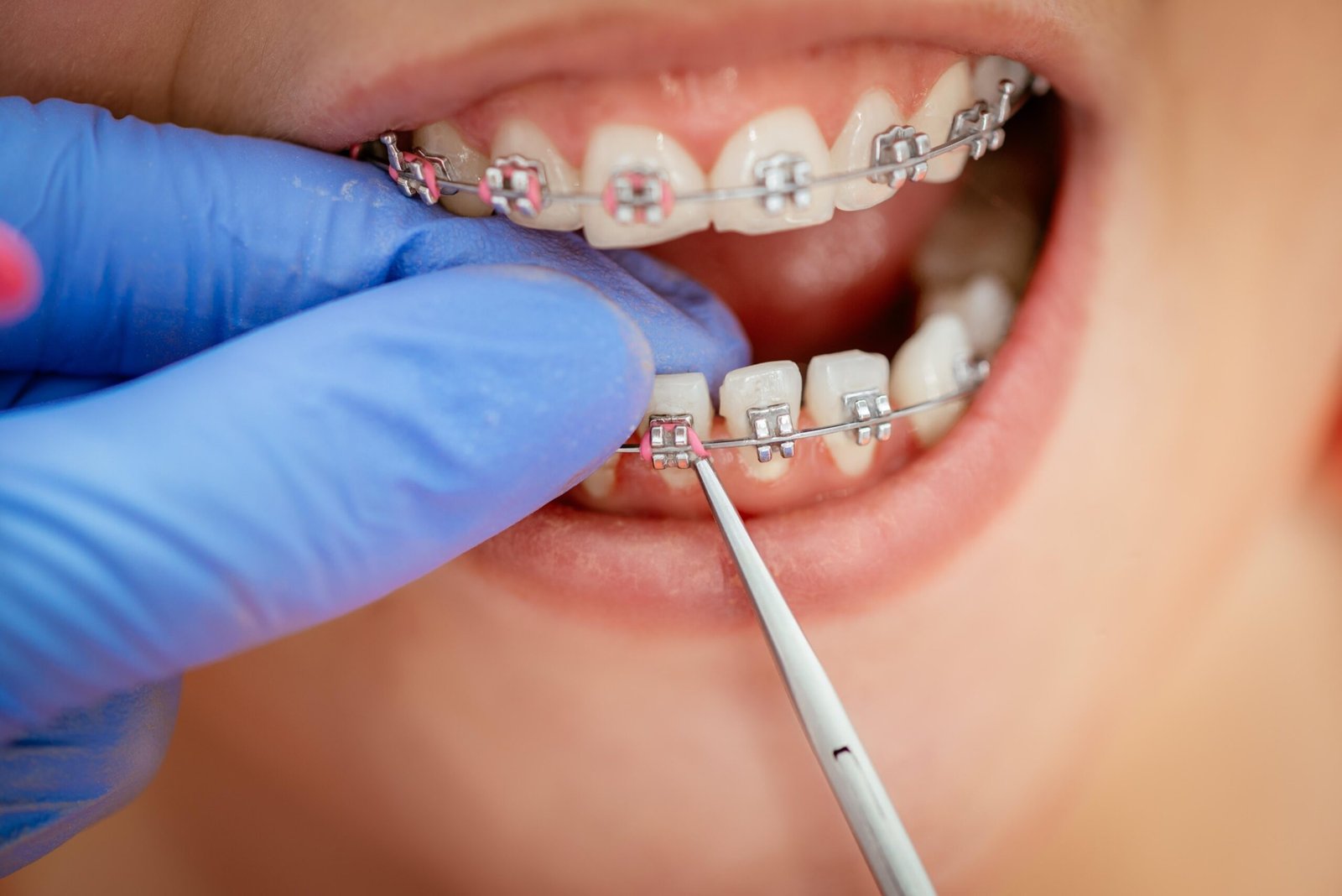Read more about the article Orthodontic Treatment in Baghajatin