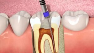 Read more about the article Root Canal Treatment: Pain Relief and Tooth Salvation