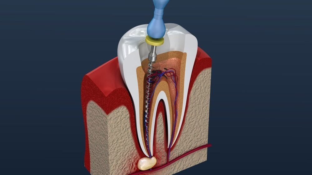 Root canal treatment