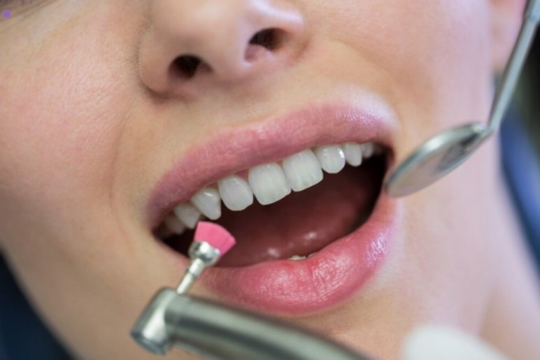 What Are Dental Crowns?