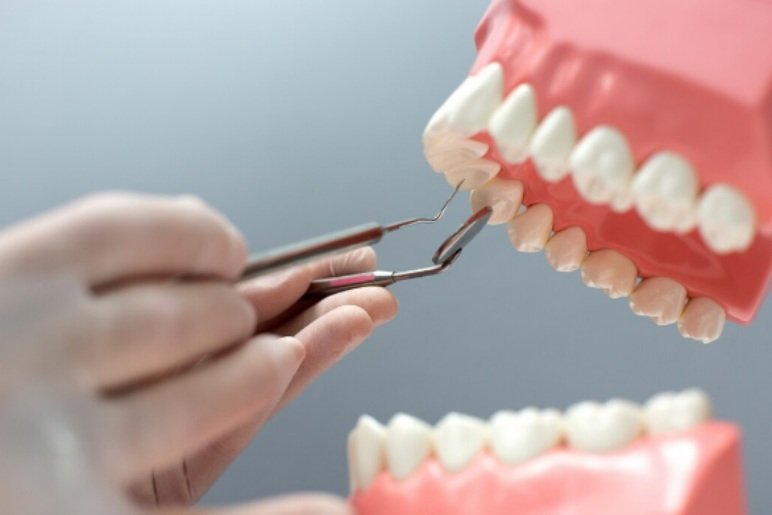 Difference Between Veneers and Crown