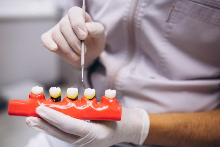 How Does Single Sitting Root Canal Work?