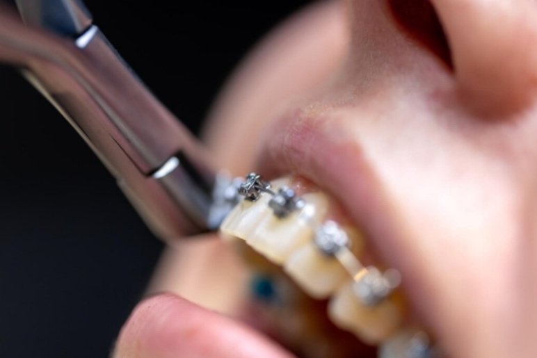 Is Single Sitting RCT Good?