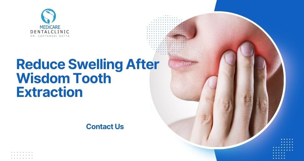 You are currently viewing How to Reduce Swelling After Wisdom Tooth Extraction