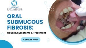 Read more about the article Oral Submucous Fibrosis: Causes, Symptoms & Treatment