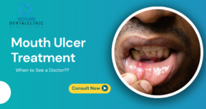 Read more about the article Mouth Ulcer Treatment: When to See a Doctor