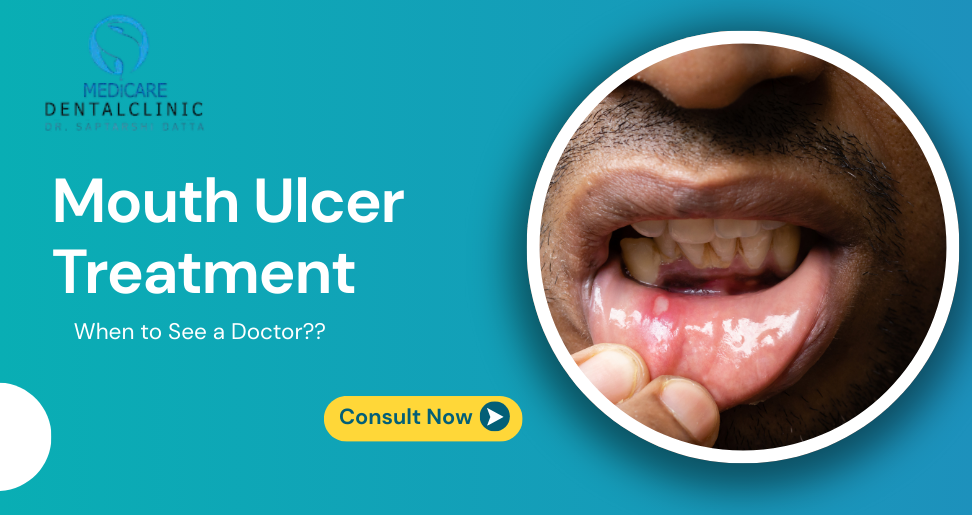 You are currently viewing Mouth Ulcer Treatment: When to See a Doctor