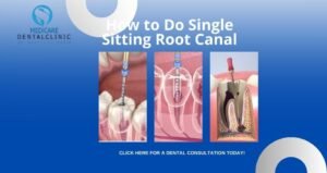 Read more about the article How to Do Single Sitting Root Canal? 2026 Updated