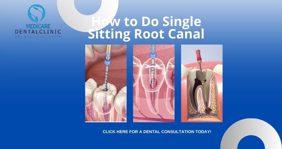 You are currently viewing How to Do Single Sitting Root Canal? 2026 Updated