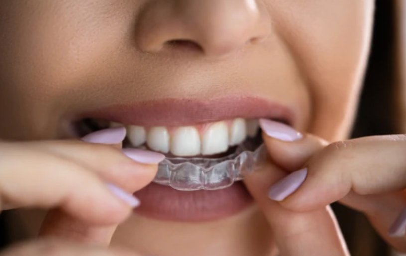 Invisible Teeth Clip | Medicare Dental