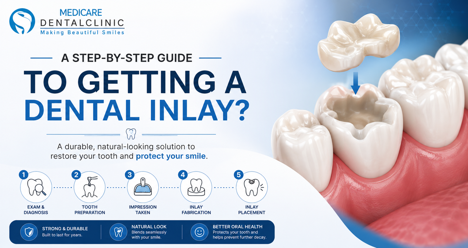 A Step-by-Step Guide to Getting a Dental Inlay?