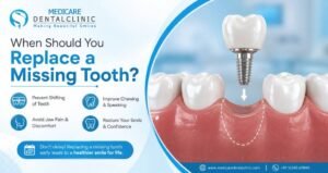 Read more about the article When Should You Replace a Missing Tooth?